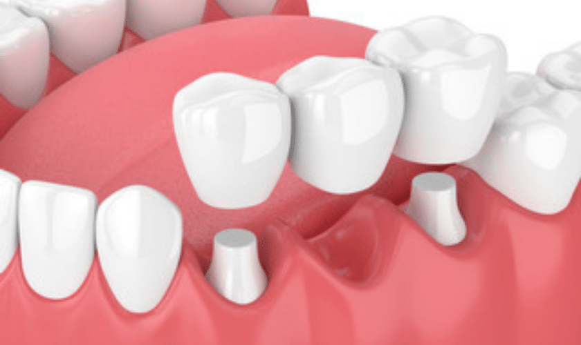 dental crown information